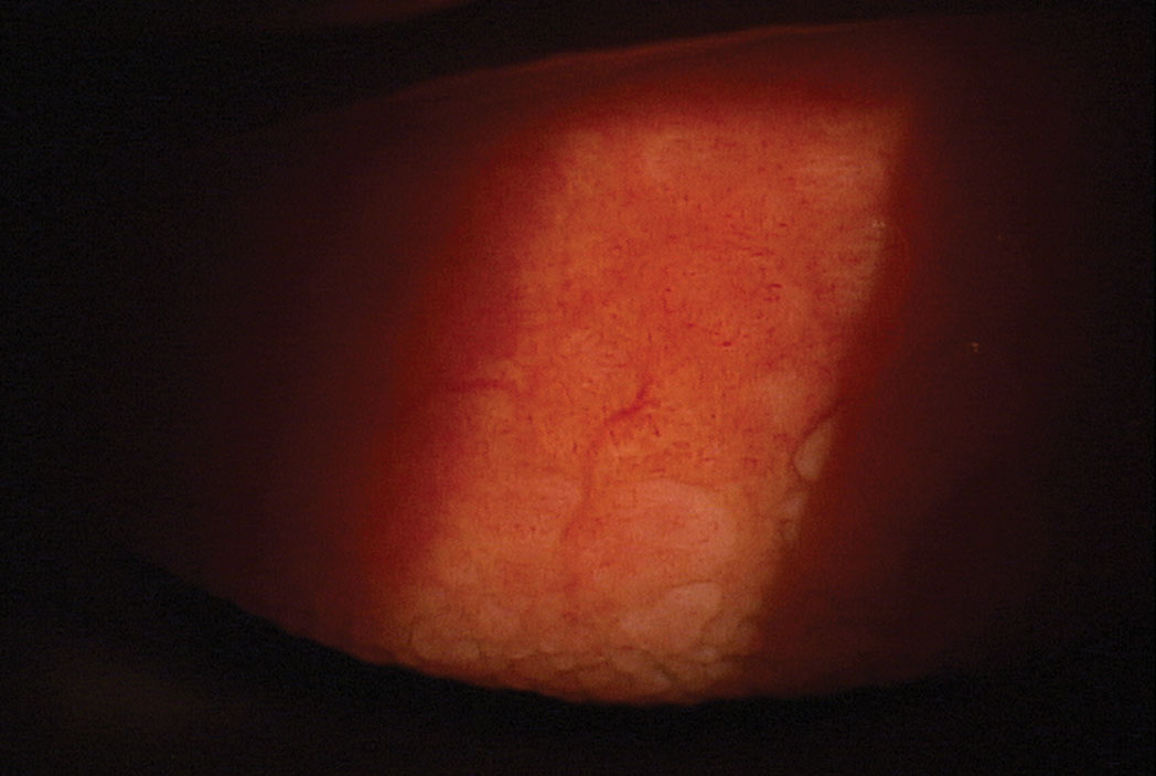 Vernal keratoconjunctivitis after treatment.