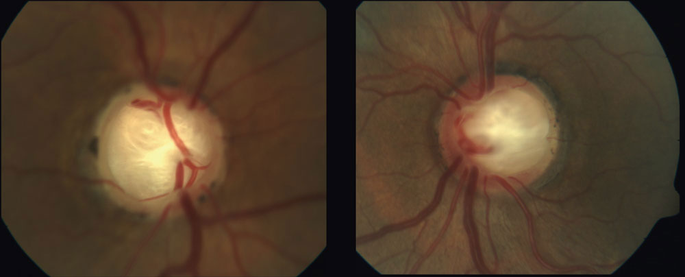 IOP may increase with age in NTG patients. Photo: Jennifer Sanderson, OD, Andrew Rixon, OD, and James Williamson, OD.