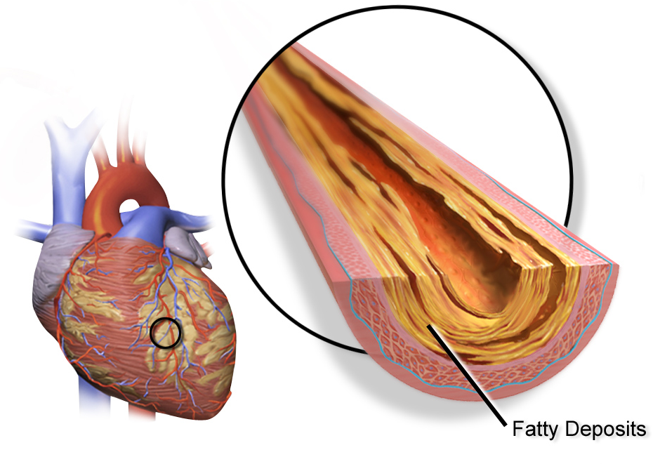 Plaque build-up in the arteries reduces blood flow, and hence oxygenation. An association with visual impairment argues for greater intervention by optometrists. Photo: Blausen.com staff (2014)/WikiJournal of Medicine. 