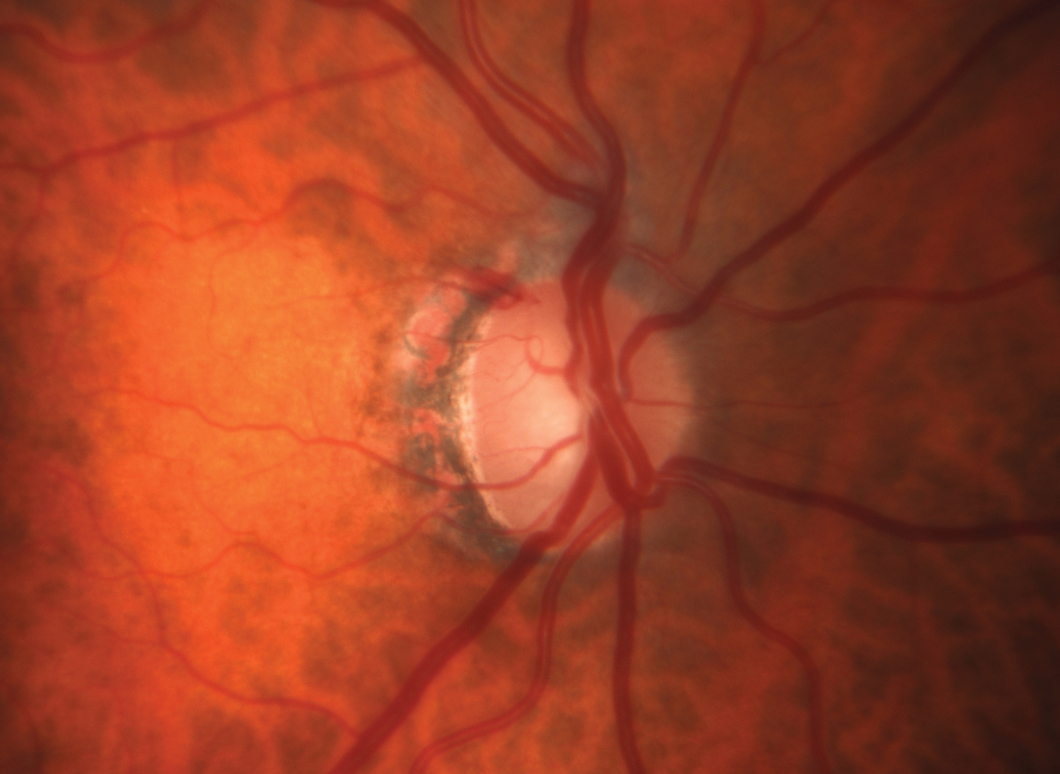 Hemoglobin levels in the optic nerve head are associated with glaucomatous damage. 