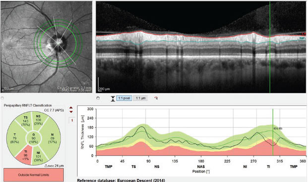 Clinicians are increasingly aware of the potential for so-called “red disease” artifacts in high myopes. Photo: Jim Fanelli, OD. 