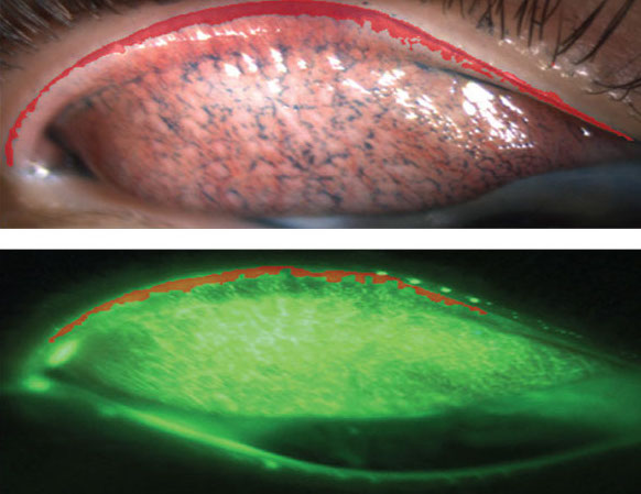 The areas colored in red outline what is considered to be lid wiper epitheliopathy. 