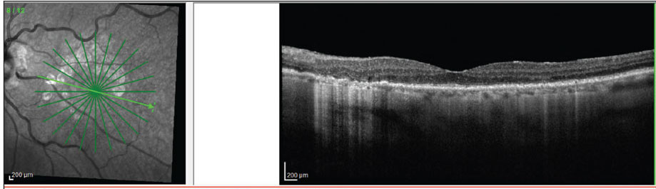 This study showed that RPE-BM distance may contribute to GA growth. Photo: Jessica Haynes, OD.