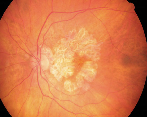 The presence of choroidal hypertransmission defects could predict GA formation.