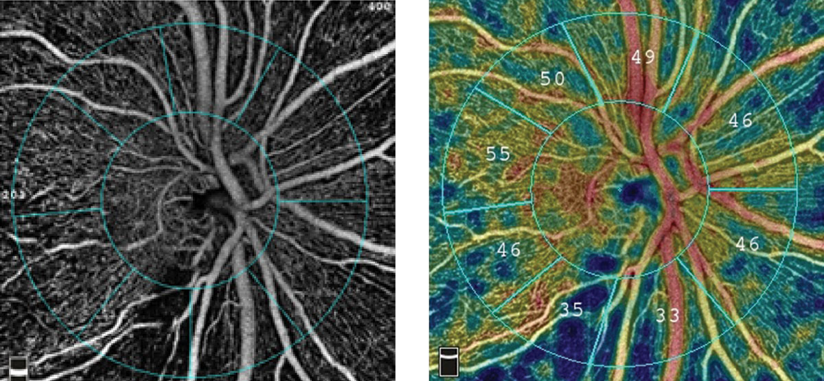 The pathogenesis of GON may involve systemic vascular dysregulation. Photo: Optovue.