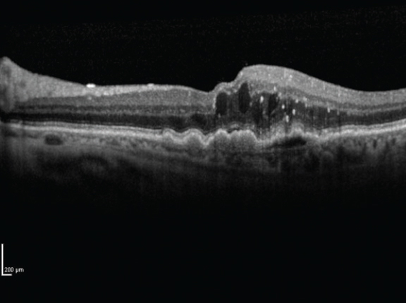 Calcium channel blockers, which treat hypertension, could be linked to an increased risk of wet AMD.