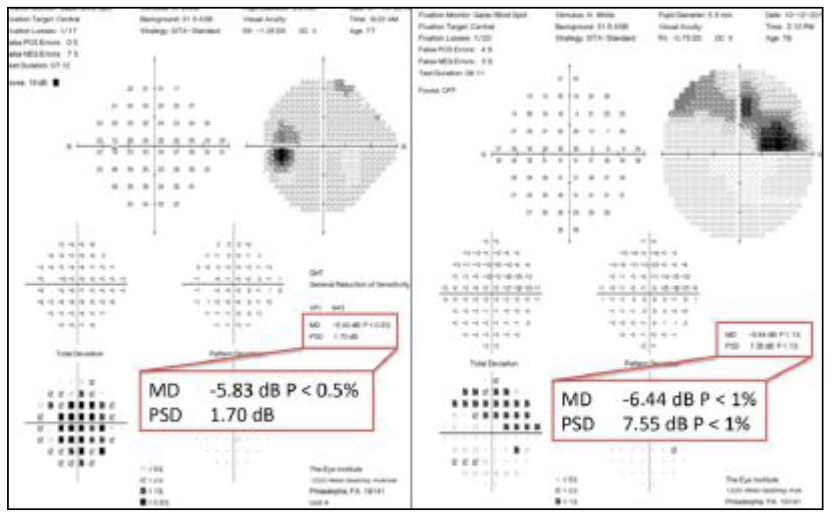 10-2 remains one of the most effective and important tests to evaluate visual field.