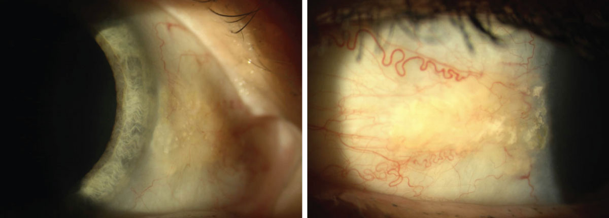 Asymptomatic nasal and temporal pingueculae in a 60-year-old Caucasian female.