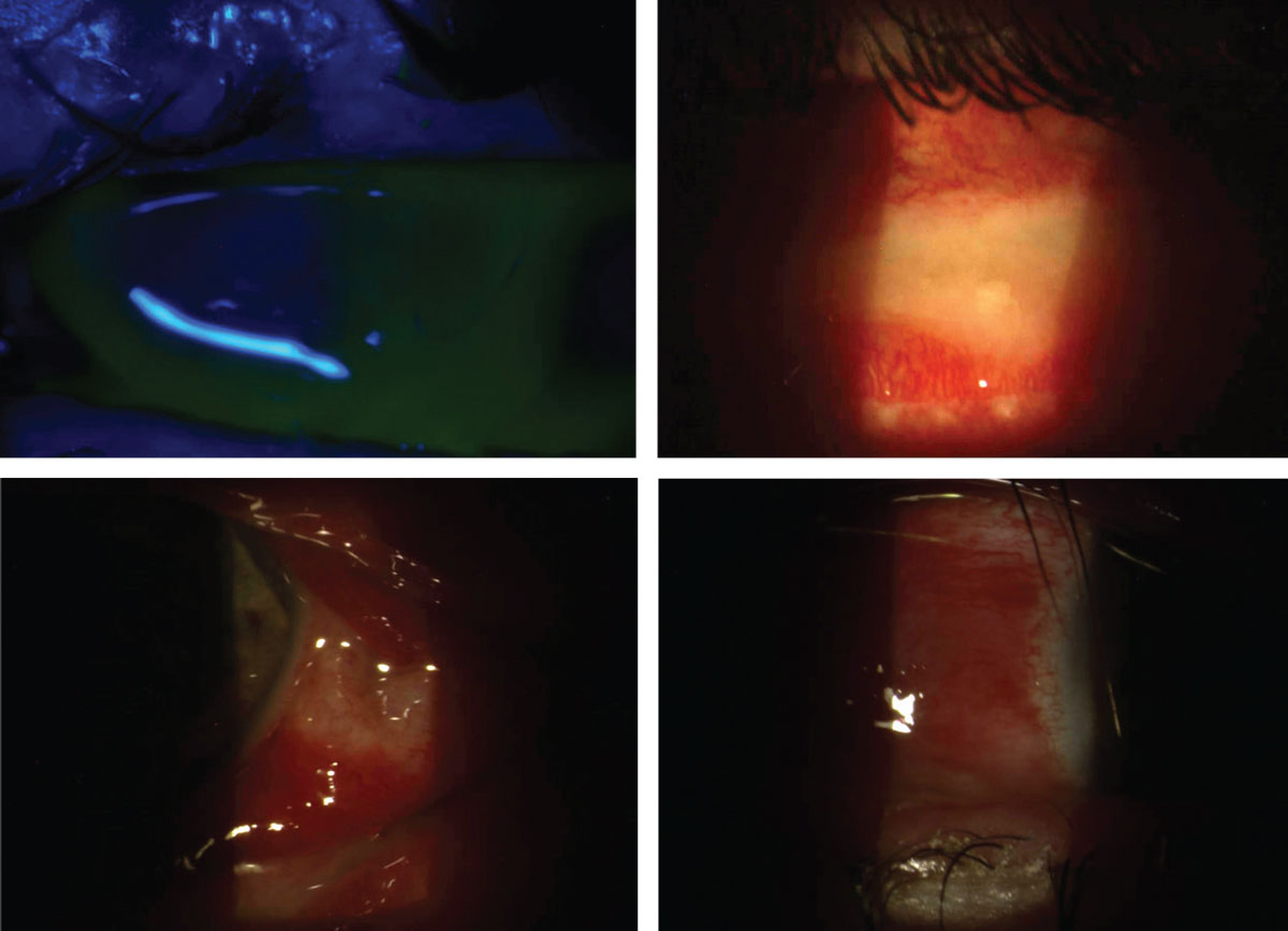 Severe mucopurulent bacterial conjunctivitis with significant lid swelling, ecchymosis, conjunctival injection and chemosis in a 30-year-old Caucasian male. Symptoms had started four days prior and seemed to be worsening daily. The patient was referred from his primary care provider. He denied any history of contact lens wear or trauma. The patient had a positive history for unprotected intercourse with a new partner two days prior to the onset of symptoms, but neither had genitourinary symptoms and his female partner had no ocular symptoms. Based on the severity of discharge, gonococcal conjunctivitis was suspected. The discharge was cultured, and the patient was sent for a 1g IM injection of ceftriaxone and placed on moxifloxacin hourly. He was instructed to keep the lids as clean as possible and regularly flush out the discharge with saline. He was followed daily to monitor for corneal involvement. Ultimately, testing came back negative for gonococcal disease, chlamydia and syphilis. With this negative result, an especially severe Staph. or Strep. infection was suspected.