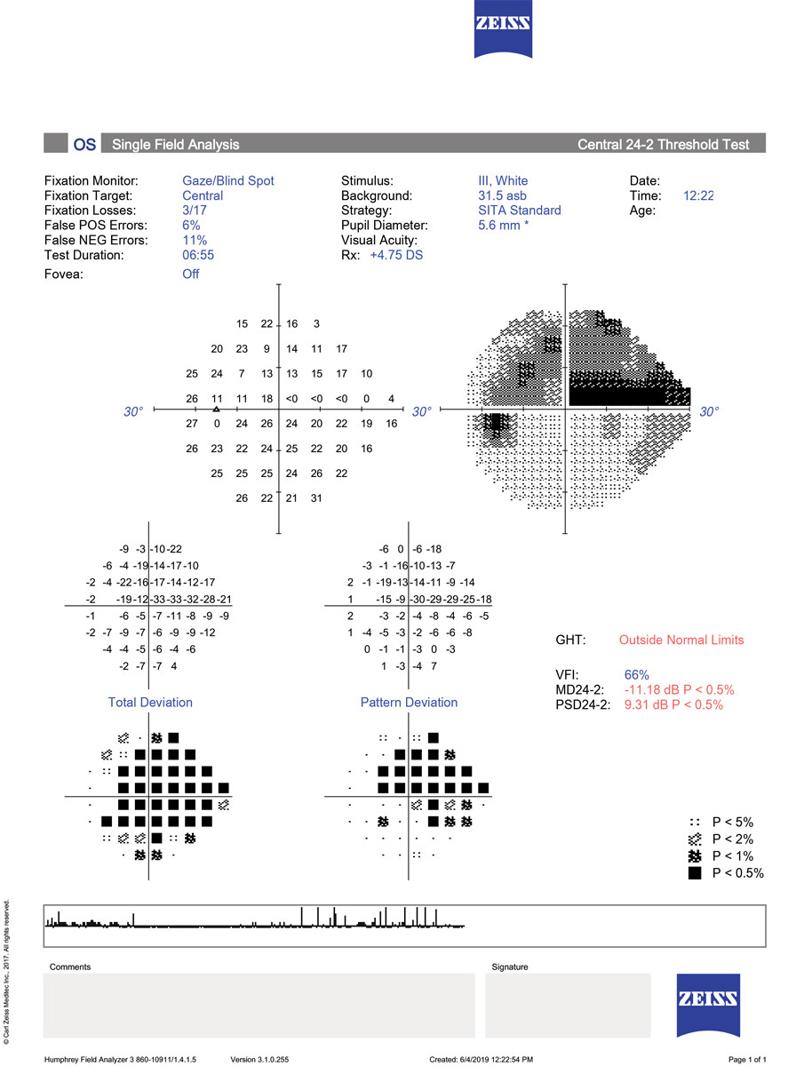 Remote MRF visual fields are comparable with HFA testing. Photo: Danica Marrelli, OD.