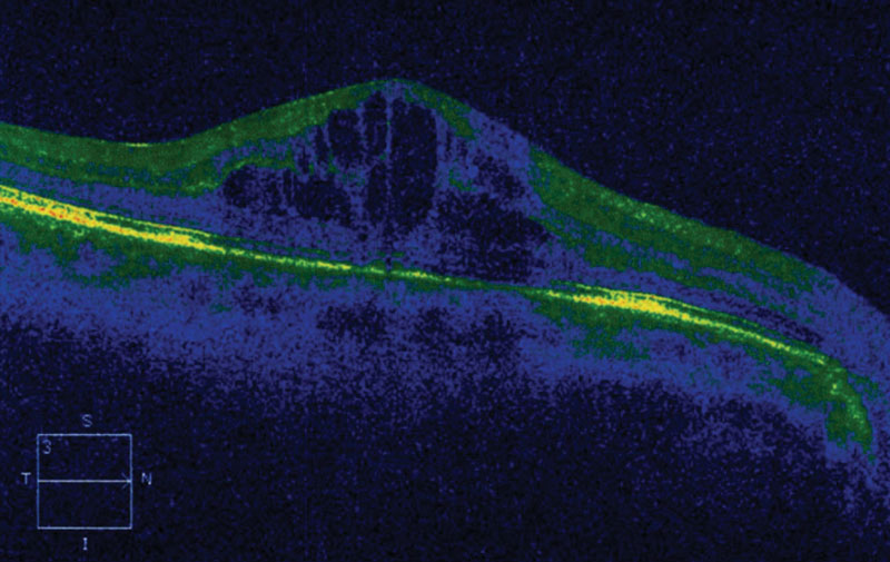 Macular edema is accompanied by a higher financial burden. Photo: Joseph W. Sowka, OD. 