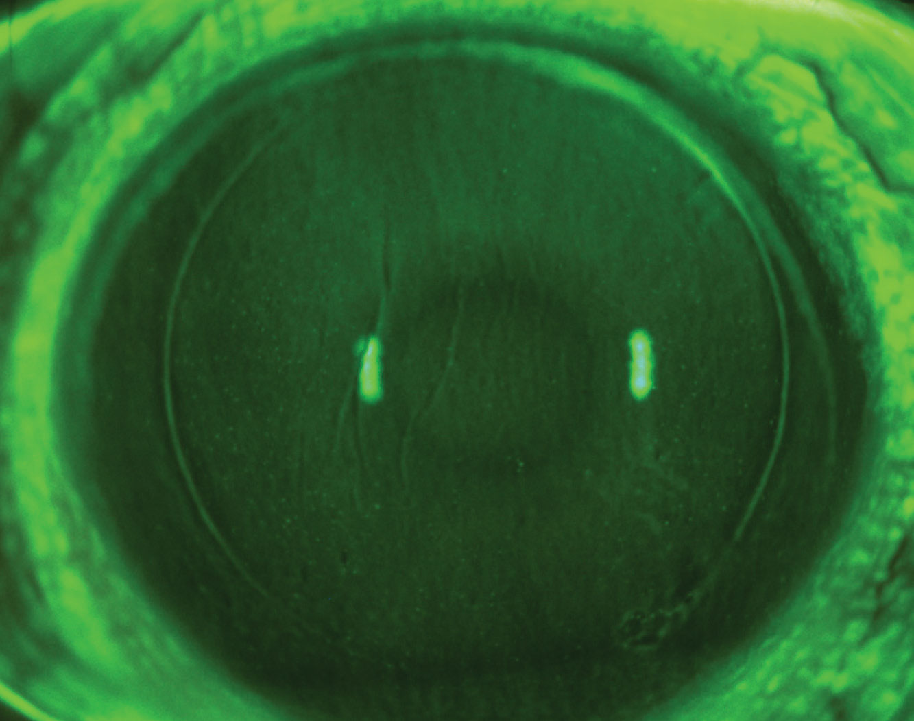 LASIK-induced dry eye with diffuse SPK and micorostriae.