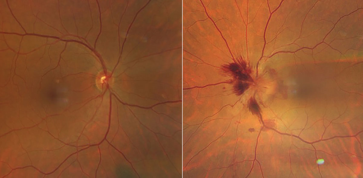 Fig. 1. Images of the right and left eyes. Note the appearance of the left eye with obvious fundus changes. 