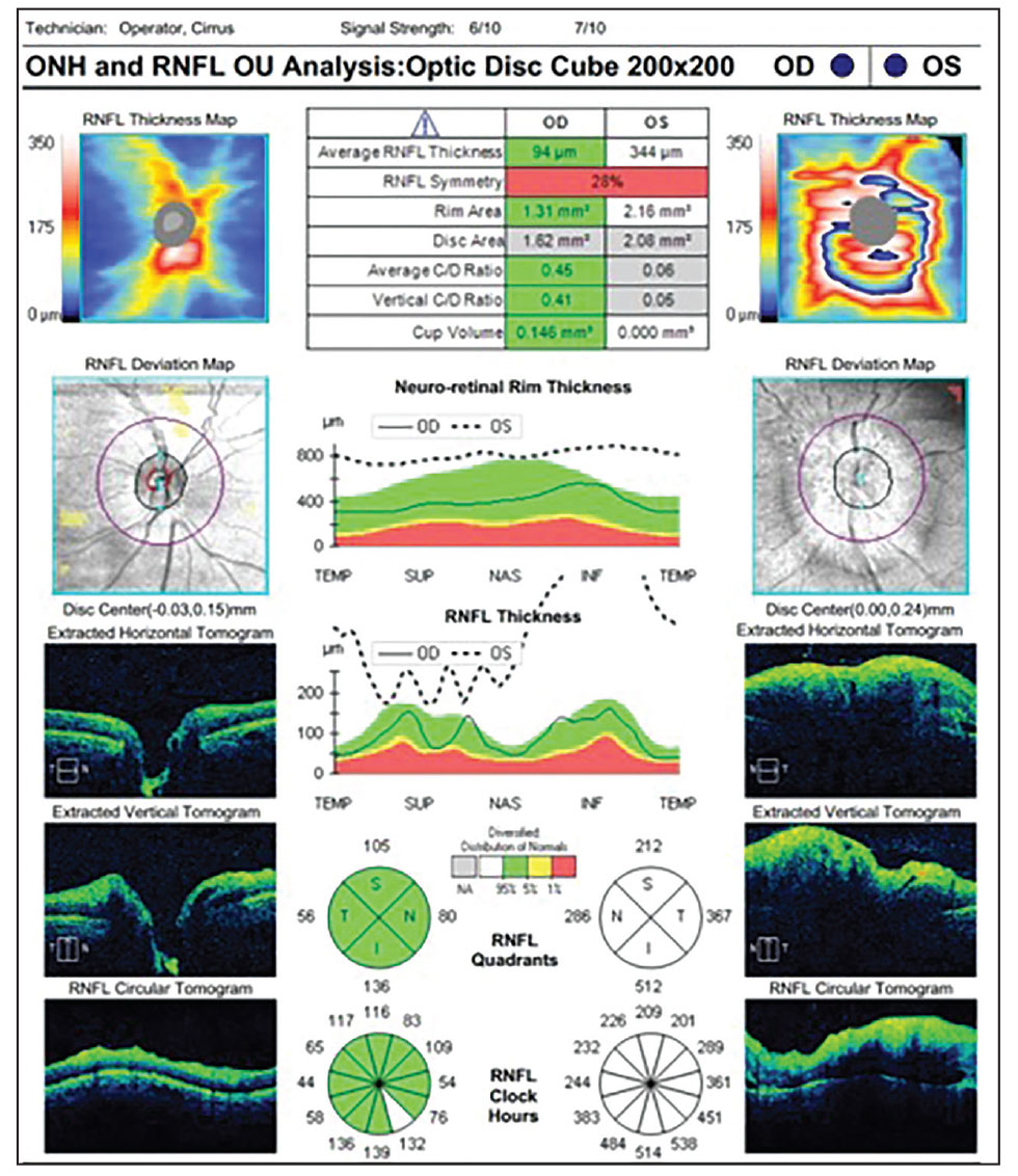 Fig. 2. OCT of the right and left eyes. How do you explain the RNFL findings in the left eye?