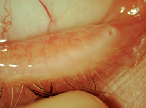 Dysbiosis more commonly presents on the ocular surface microbiota of allergic conjunctivitis patients. Photo: Charissa Young, OD. 