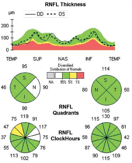 RNFL thicknesses vary between people of different ethnicities, study shows. Photo: Ryan Schott, OD.