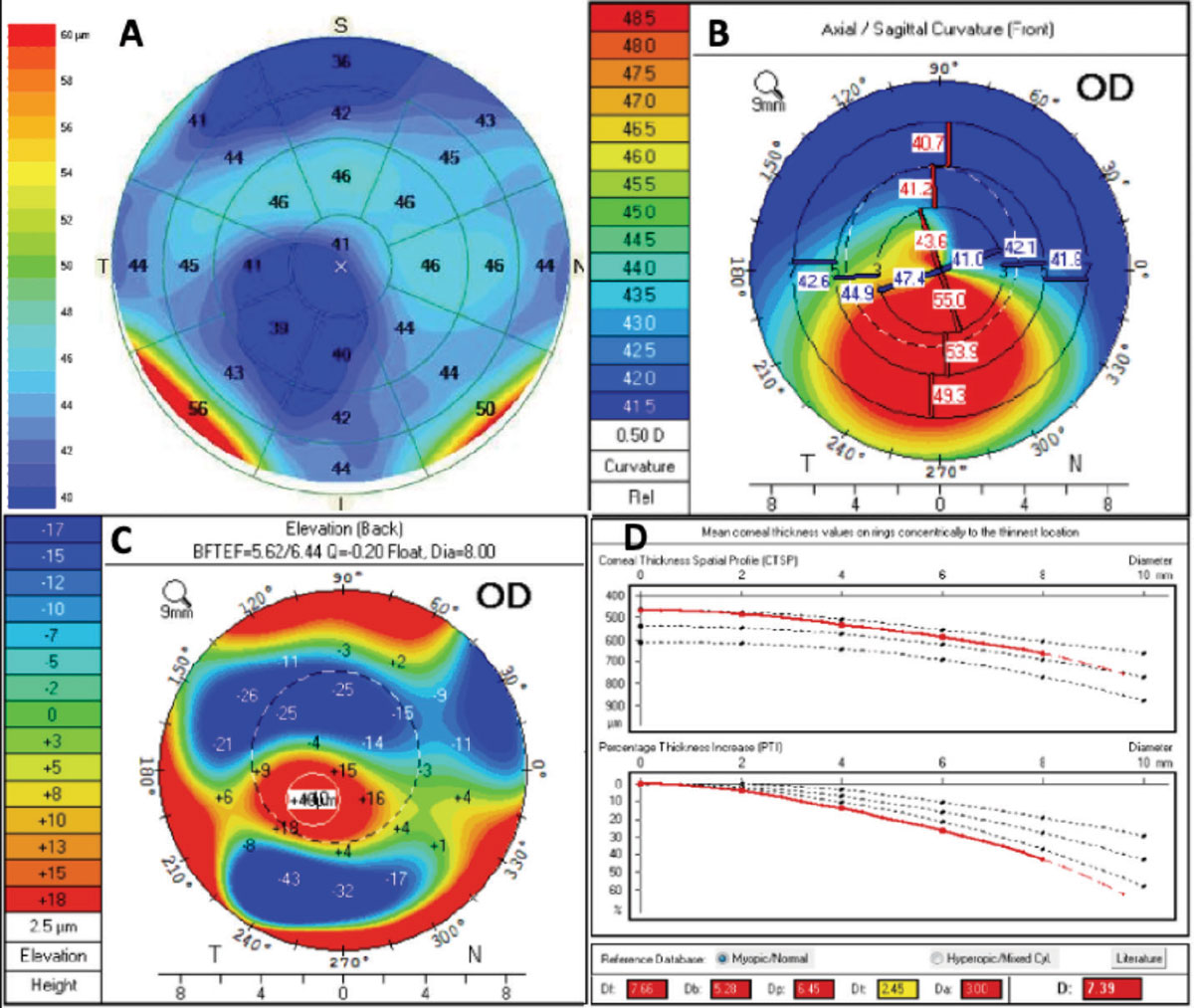 Fig. 1. This patient with keratoconus presented for a refractive surgery consult. OCT epithelial thickness (A) mapping showed thinning of the epithelium that corresponded with inferior steepening (B) and posterior float (C) on the pentacam image. The Belin/Ambrosio deviation display shows an abnormal “D” value consistent with keratoconus.