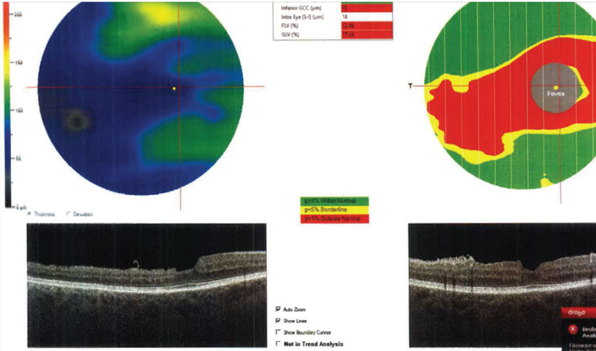 Macular ganglion cell complex thickness on OCT helps predict glaucoma progression. Photo: Julia Reimold, OD, and Chris Wroten, OD.