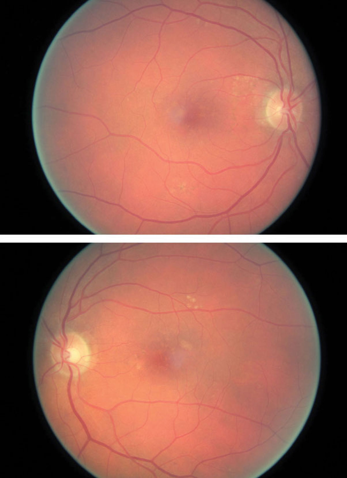 Peak emission wavelength may play a role in AMD diagnosis. Photo: Amanda Legge, OD.