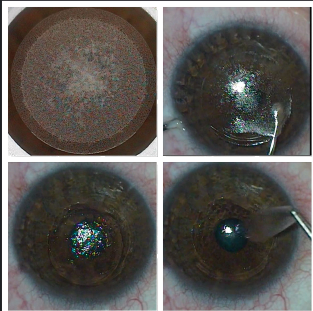 Patients who received SMILE demonstrated better image quality than those who received PRK or FS-LASIK. 