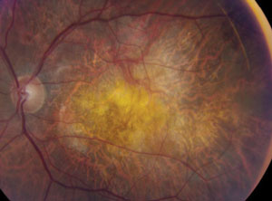 A low BCVA in addition to the presence of IRF could indicate a risk of subretinal fibrosis.