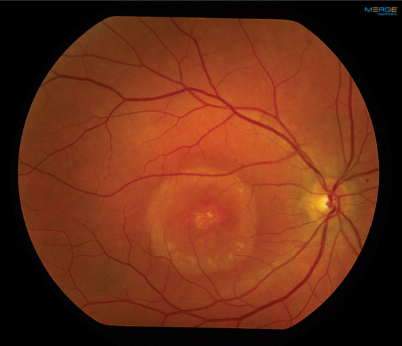 Close monitoring is crucial for patients with PPS, as the disease shares similarities with similar but distinct conditions.