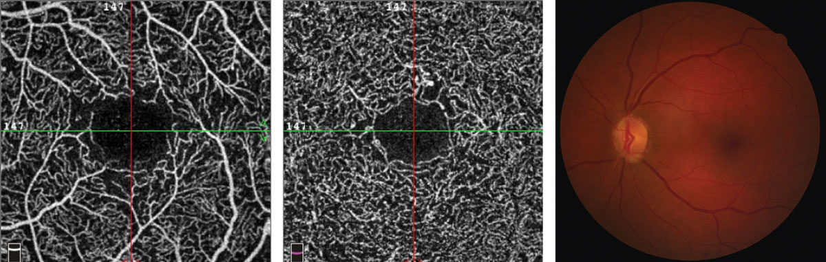 This 65-year-old female has enlarged foveal avascular zone with indistinct borders, capillary nonperfusion surrounding the fovea with scattered areas devoid of flow and microaneurysms.