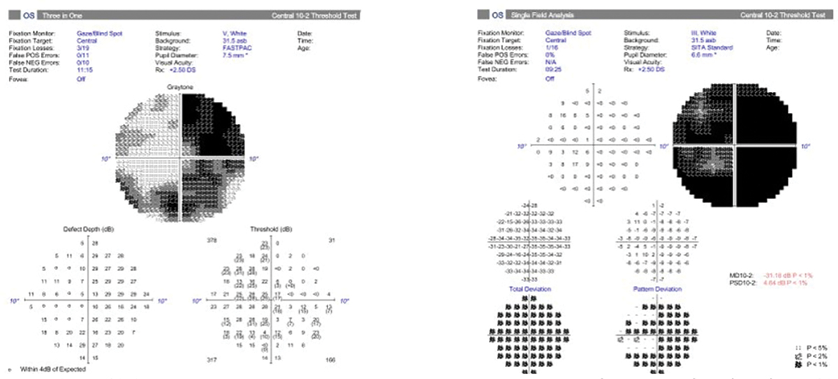 Fig. 7. A 10-2 visual field with a size III target showing a generalized depression (right). Beside it is a 10-2 of the same patient with a size V target showing a better visualization of the pattern of visual field loss (left). The bigger stimulus size may allow for easier determination of progression.