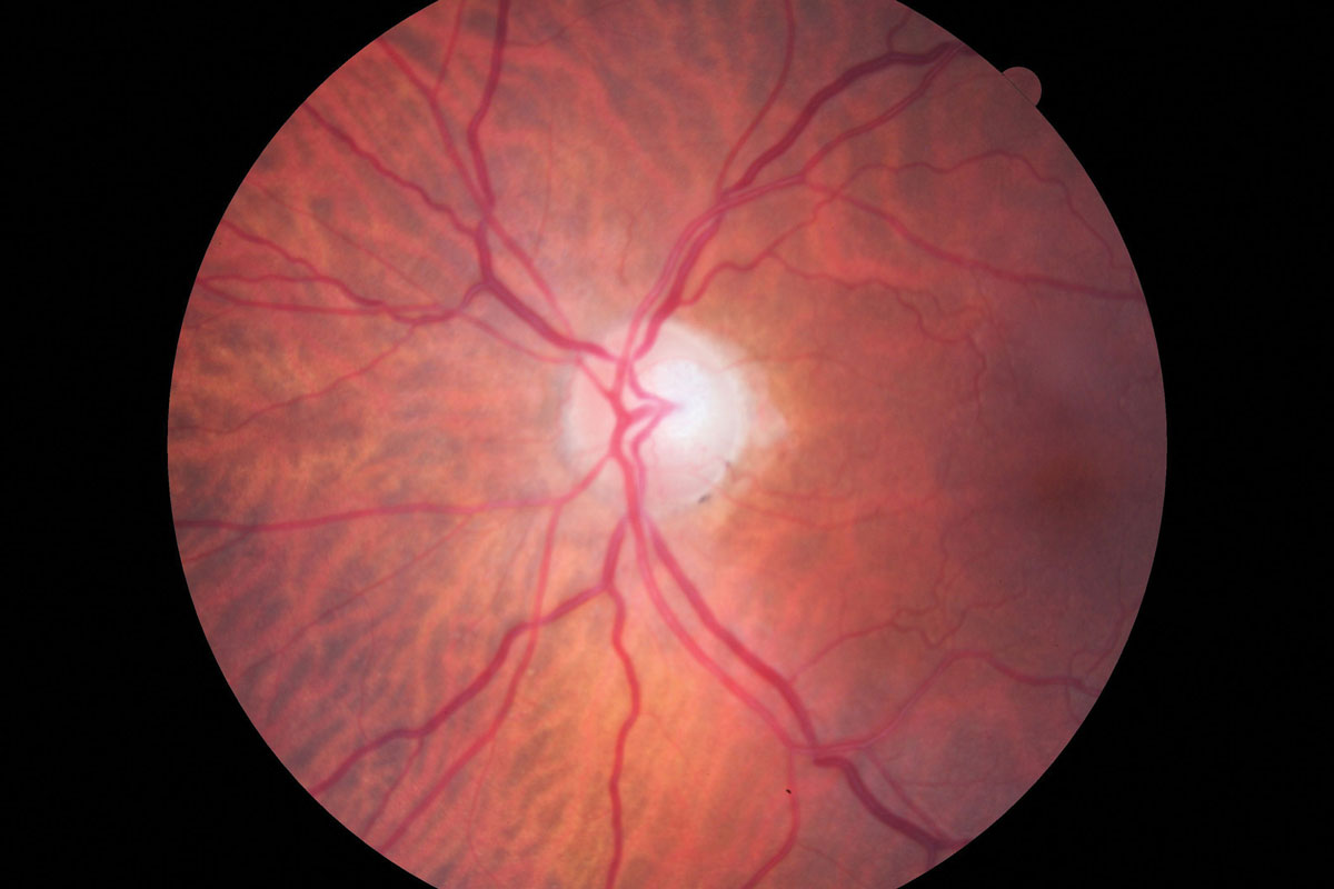 Peripapillary vessel density aids in predicting visual function.