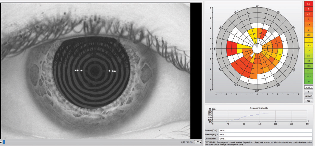 Patients with Sjögren’s DED were found to have a shorter tear film breakup time and. overall worse visual outcomes than those with DED from other causes.