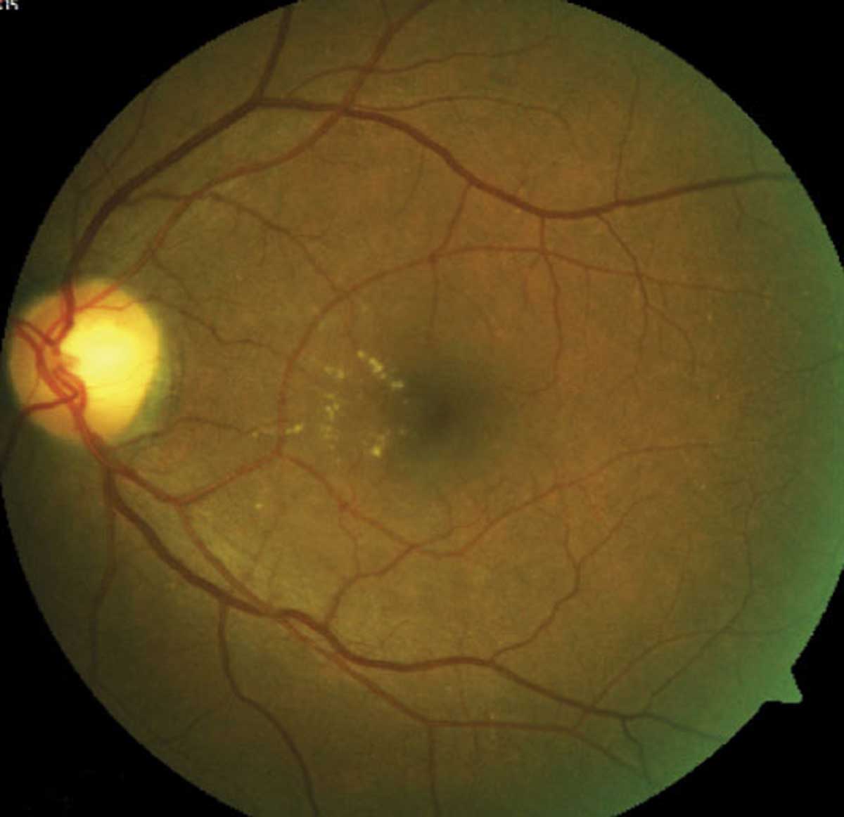 No correlation between DME development and DR severity was found in this study.