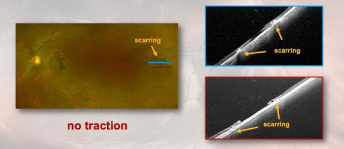 Optos photography and corresponding OCT showing a temporal retinal hole with scarring but without surrounding subretinal fluid cuff in the left eye. Scarring from previous laser is seen as distinct areas of hyperreflectivity adjacent to the retinal hole (absence of neurosensory retina).