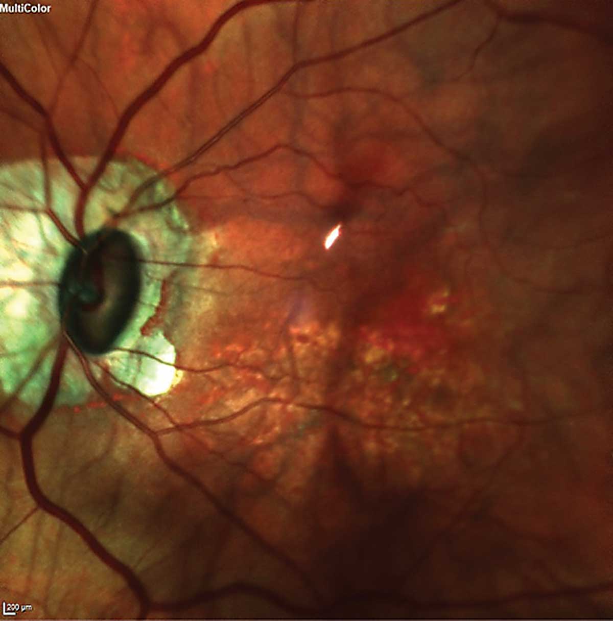 Increased disc-tilt ratio and myopia progression were both linked to a greater number of patients with RNFL defects.