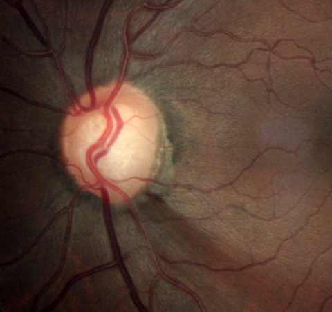 Incidence of disc hemorrhage, as well as IOP levels in affected patients, appear to be affected by temperature.