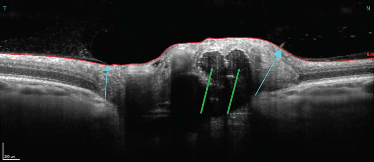 An OCT line scan with the green lines annotating some visible optic disc drusen.