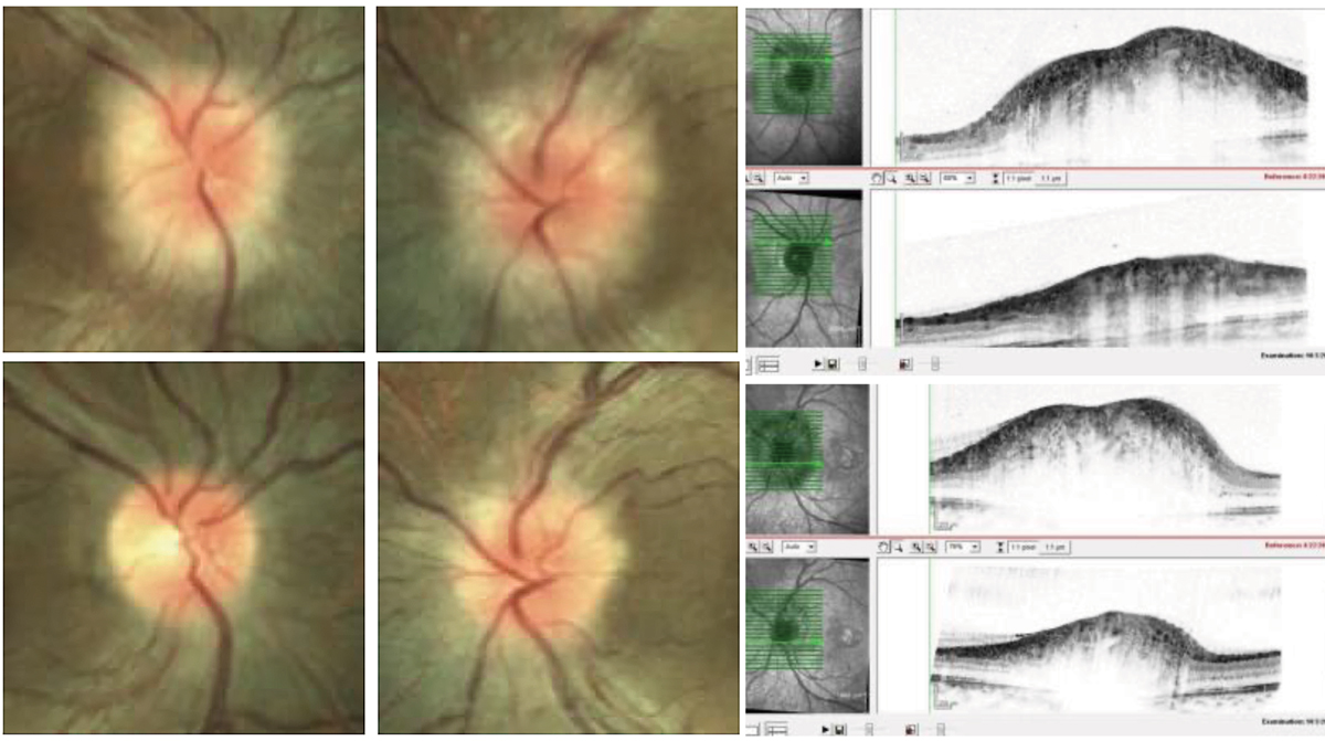 This patient with an intracranial mass seen on MRI presented with papilledema. The resolution is noted on OCT post-mass resection.
