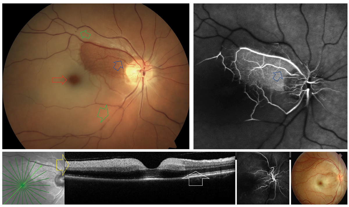 A cilioretinal artery (blue arrows) sparing CRAO. The areas of nonperfusion are noted to have retinal whitening with a prominent “cherry red spot” (red). Arterial plaques and segmentation “boxcarring” can be observed along the temporal vessels (green). On FA, significant vascular nonperfusion is noted outside the region supplied by the cilioretinal artery (blue). In the acute phase of CRAO, OCT typically reveals inner retinal hyperreflectivity (yellow). This is not present in the region spared by the cilioretinal artery (white). The upper right photo is an example of CRAO without cilioretinal sparing.