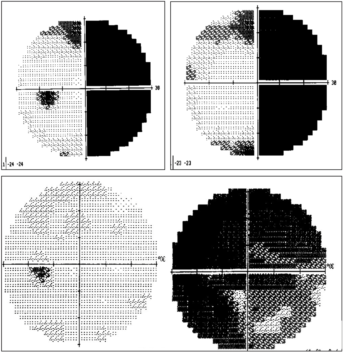 This patient developed diplopia after a car accident. He has a cranial nerve IV palsy with an up and out deviation OD shown in primary gaze, which is exaggerated by the traumatic scar on the lower lid of the same eye.