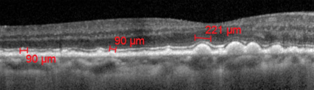 Subretinal drusenoid deposits above the RPE or soft drusen below it are two disease pathways indicated in AMD.