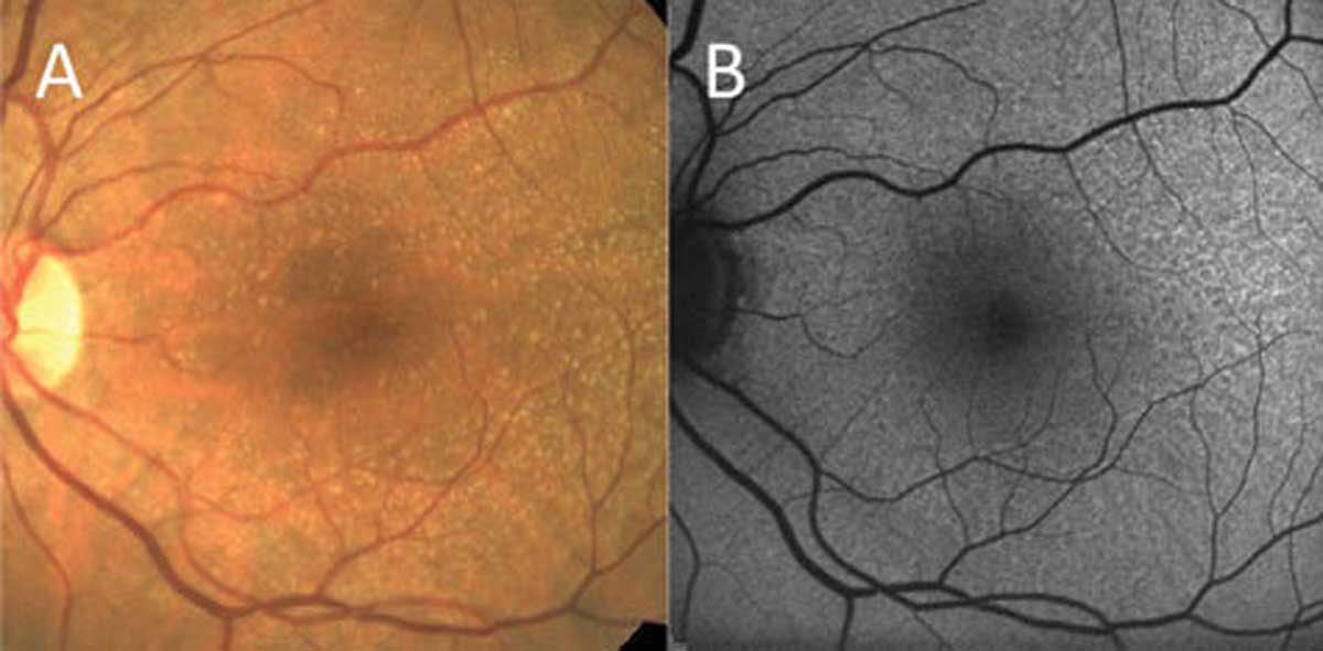 Omega-3 may be a protective factor against AMD development.