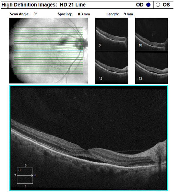 It's not common for an nAMD patient on anti-VEGF therapy to develop SMH with vision loss, study shows.