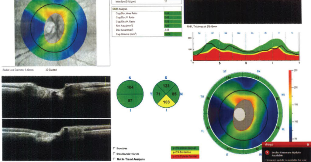 Patients with POAG or normal tension glaucoma report similar vision-related quality of life