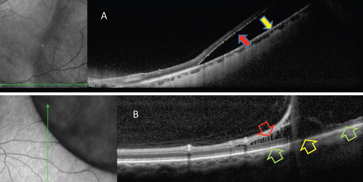 Be sure to closely monitor patients with thicker baseline choroids who undergo PPV. 