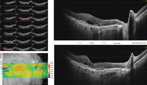 Patients who have fluctuating retinal thickness values during treatment may be more likely to have a negative response to anti-VEGF.