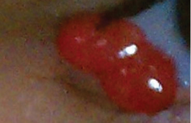 A pyogenic granuloma that occurred post-chalazion. First-line treatment is topical steroids. They are often hidden under the lid, and Chi will evert when the lid is pulled down.