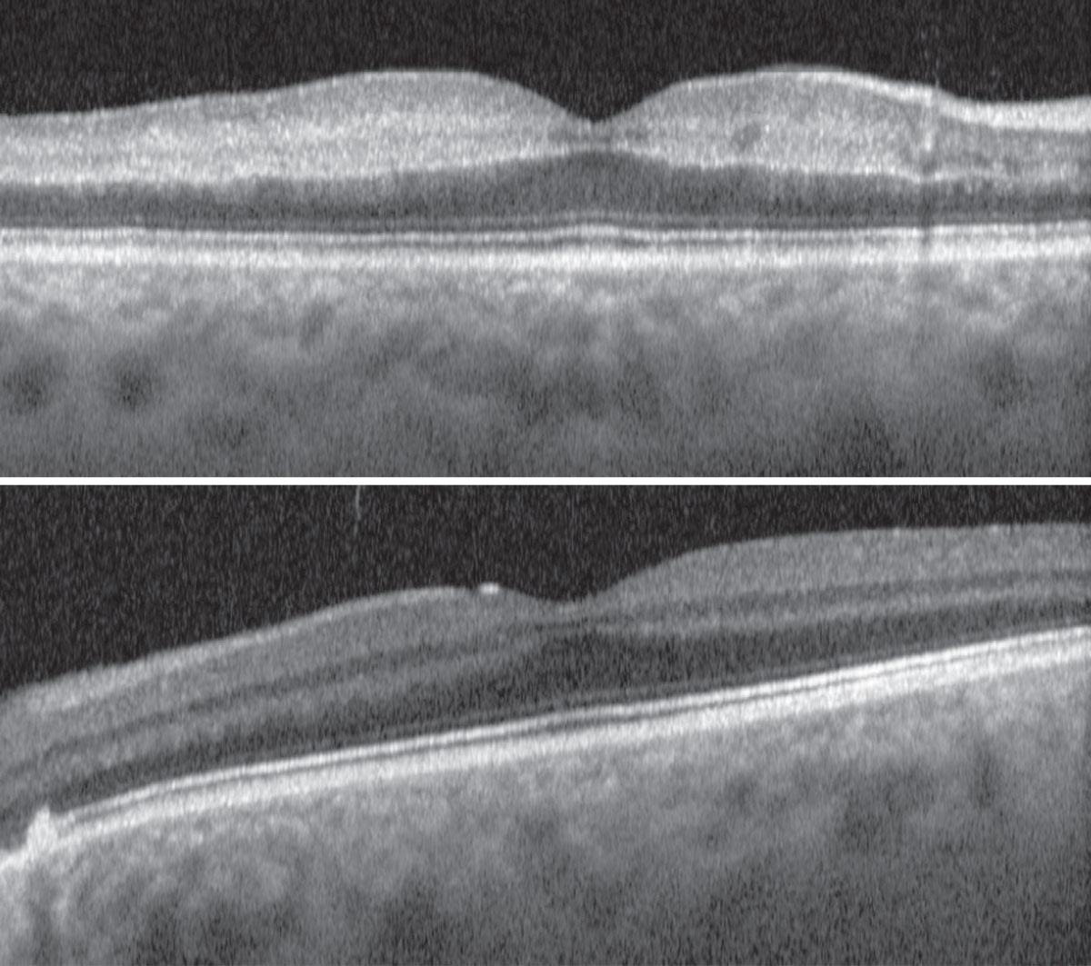 Figs. 3 and 4. OCT of the right eye (top) and left eye (bottom).