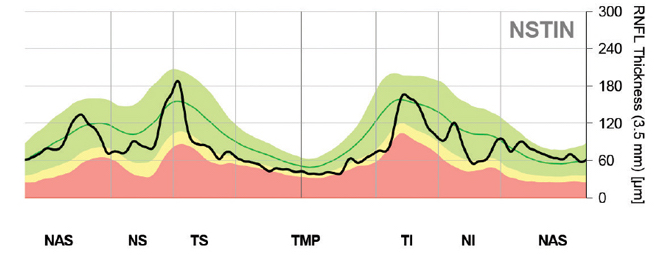 When assessing patients with prediabetes, stay alert for early loss of RNFL (seen here in a glaucoma patient). 