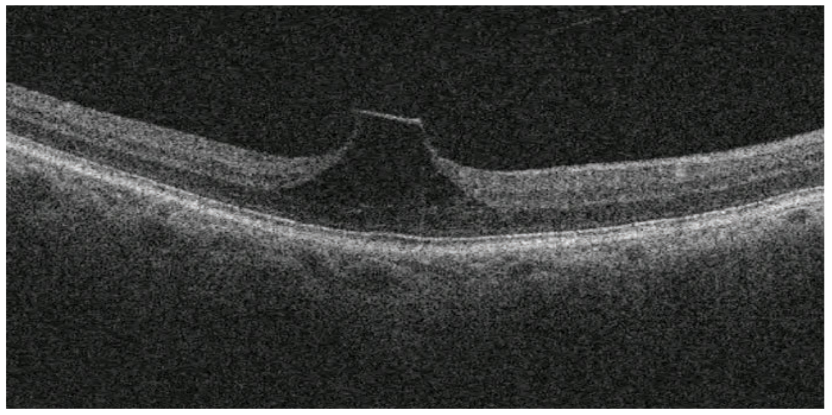 This patient has vitreomacular traction and is monitoring symptoms of metamorphopsia with at-home Amsler grid testing.