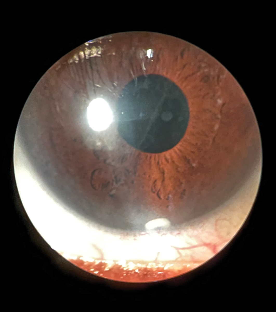 Update your Glaucoma Prescribing Protocols