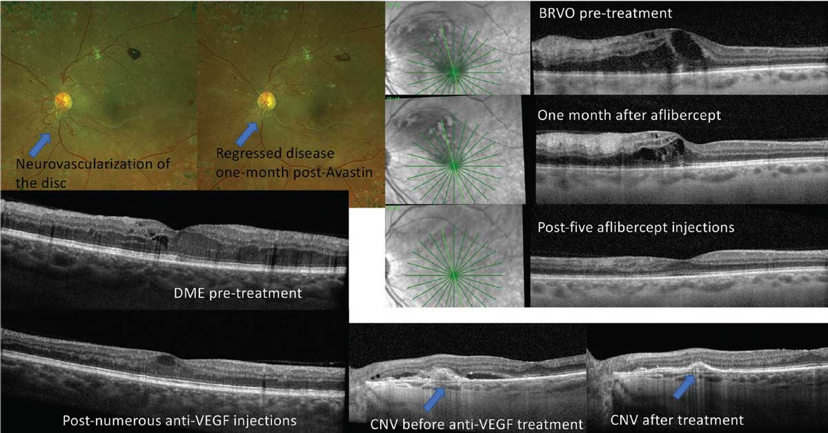 Fig 1. Anti-VEGF injections are beneficial for a wide array of posterior segment complications.